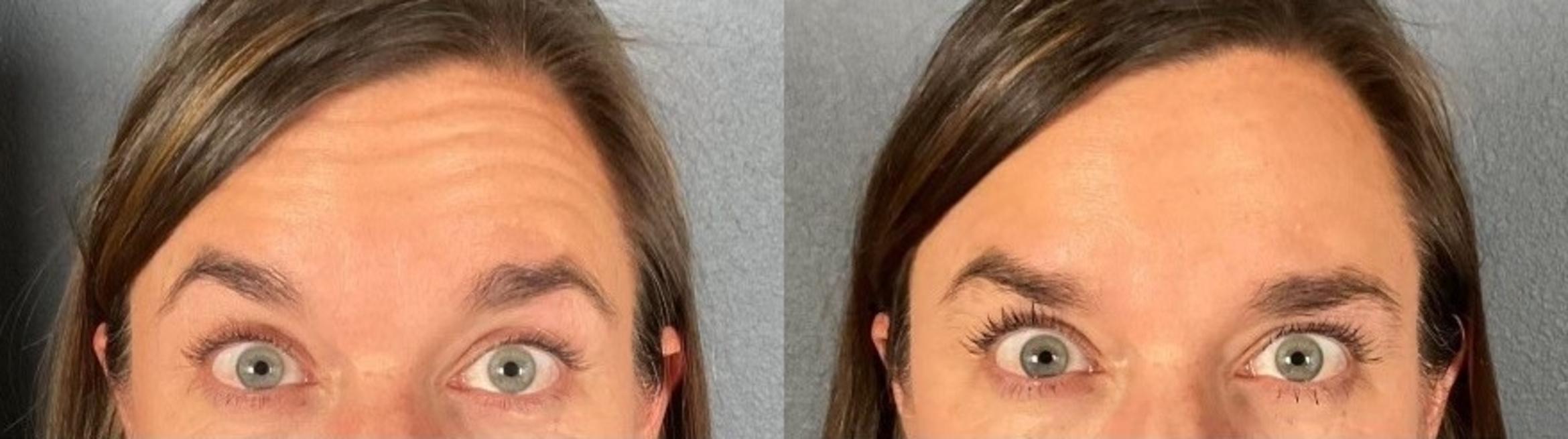 Before & After BOTOX® & Dysport® Case 1 View 1 View in Eugene, Oregon