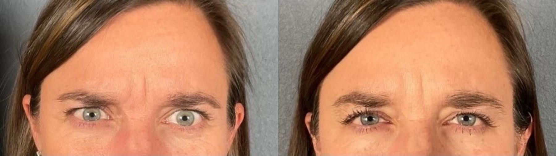 Before & After BOTOX® & Dysport® Case 1 View 2 View in Eugene, Oregon