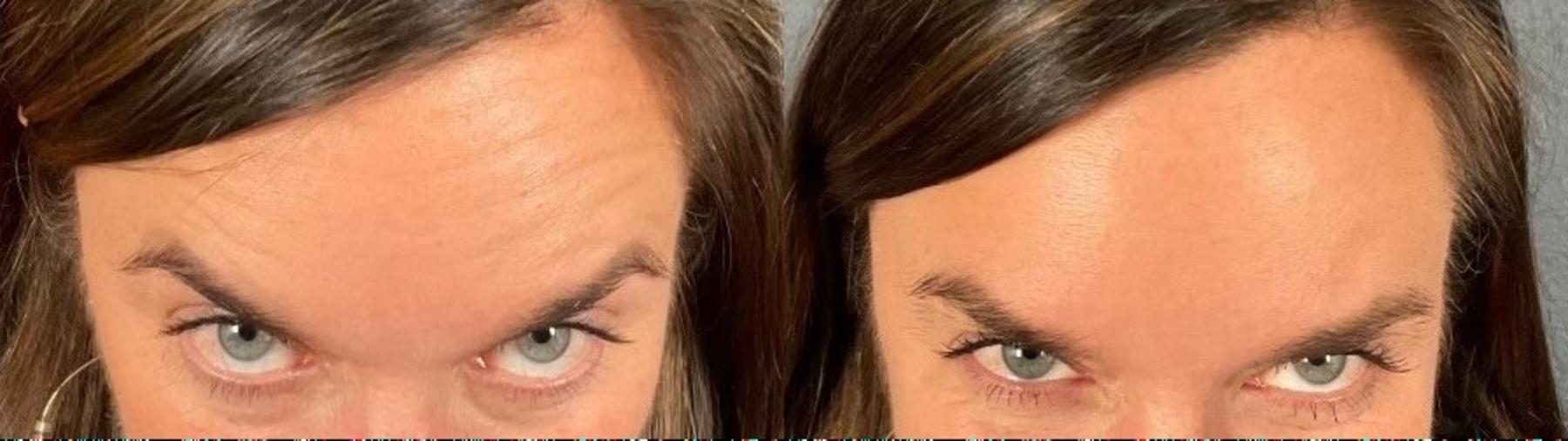 Before & After BOTOX® & Dysport® Case 1 View 3 View in Eugene, Oregon