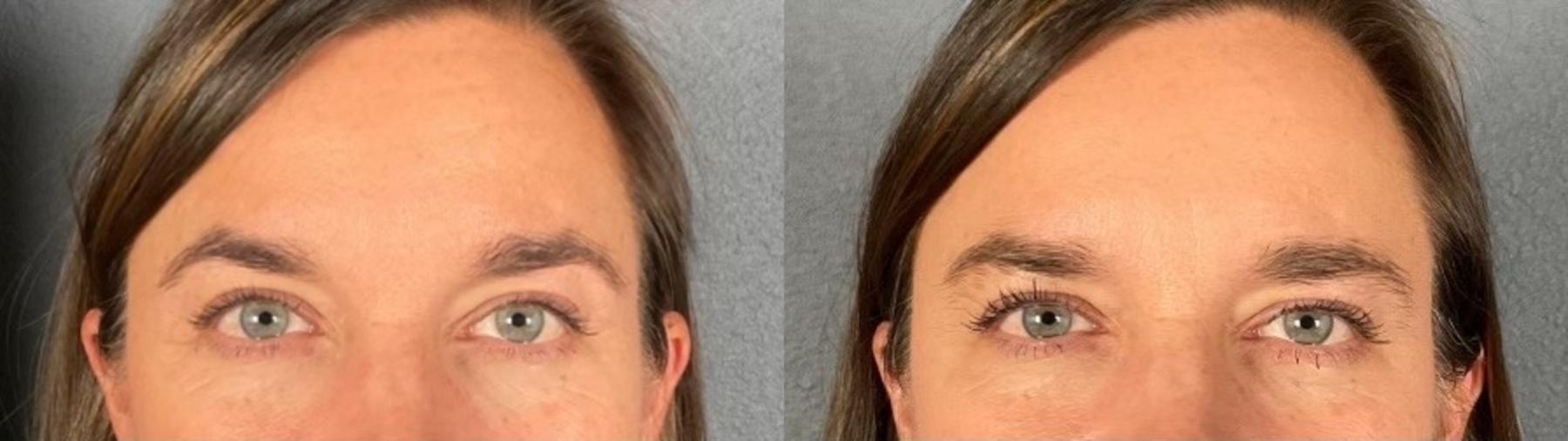 Before & After BOTOX® & Dysport® Case 1 View 4 View in Eugene, Oregon
