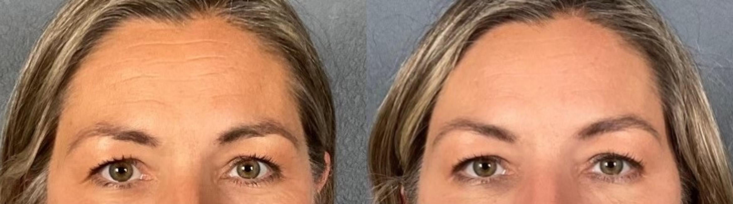 Before & After BOTOX® & Dysport® Case 2 View 1 View in Eugene, Oregon