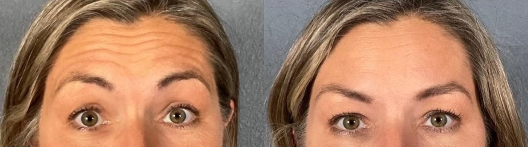 Before & After BOTOX® & Dysport® Case 2 View 2 View in Eugene, Oregon