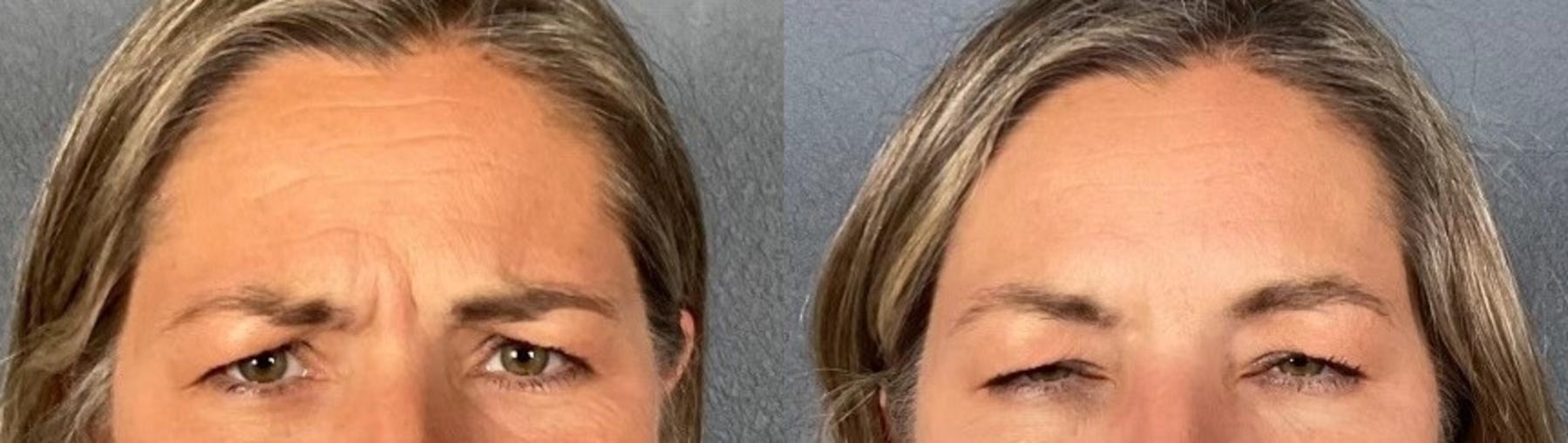 Before & After BOTOX® & Dysport® Case 2 View 3 View in Eugene, Oregon