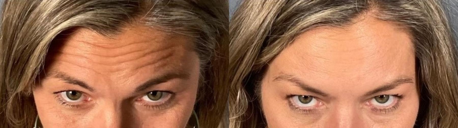 Before & After BOTOX® & Dysport® Case 2 View 4 View in Eugene, Oregon
