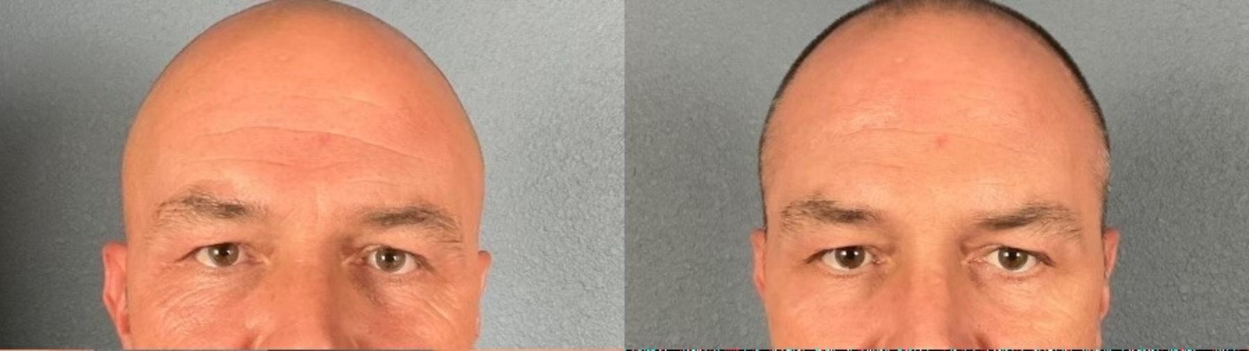 Before & After BOTOX® & Dysport® Case 3 View 1 View in Eugene, Oregon