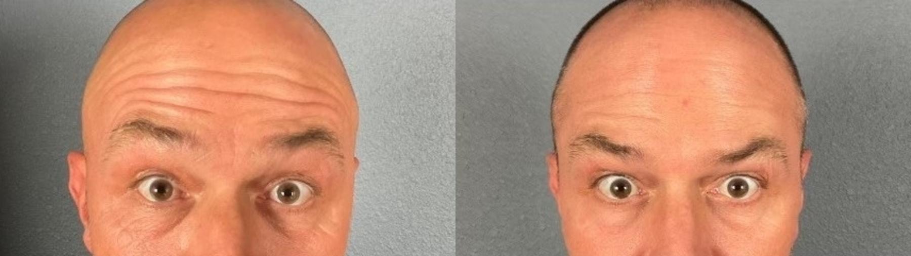 Before & After BOTOX® & Dysport® Case 3 View 2 View in Eugene, Oregon