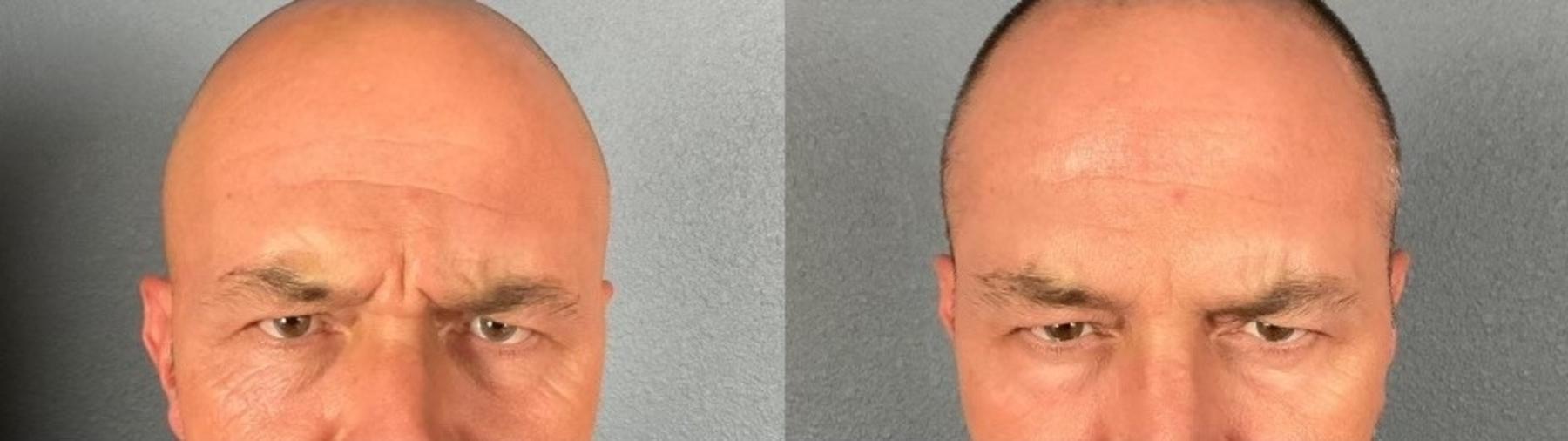 Before & After BOTOX® & Dysport® Case 3 View 3 View in Eugene, Oregon