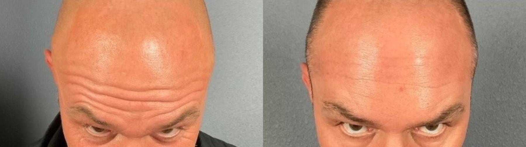 Before & After BOTOX® & Dysport® Case 3 View 4 View in Eugene, Oregon