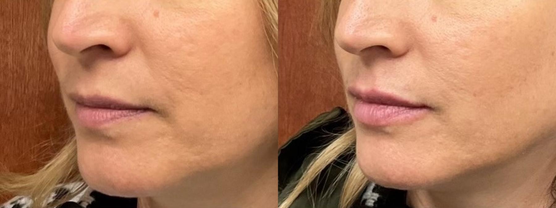 Before & After Lip Filler Case 4 Left Oblique View in Eugene, Oregon