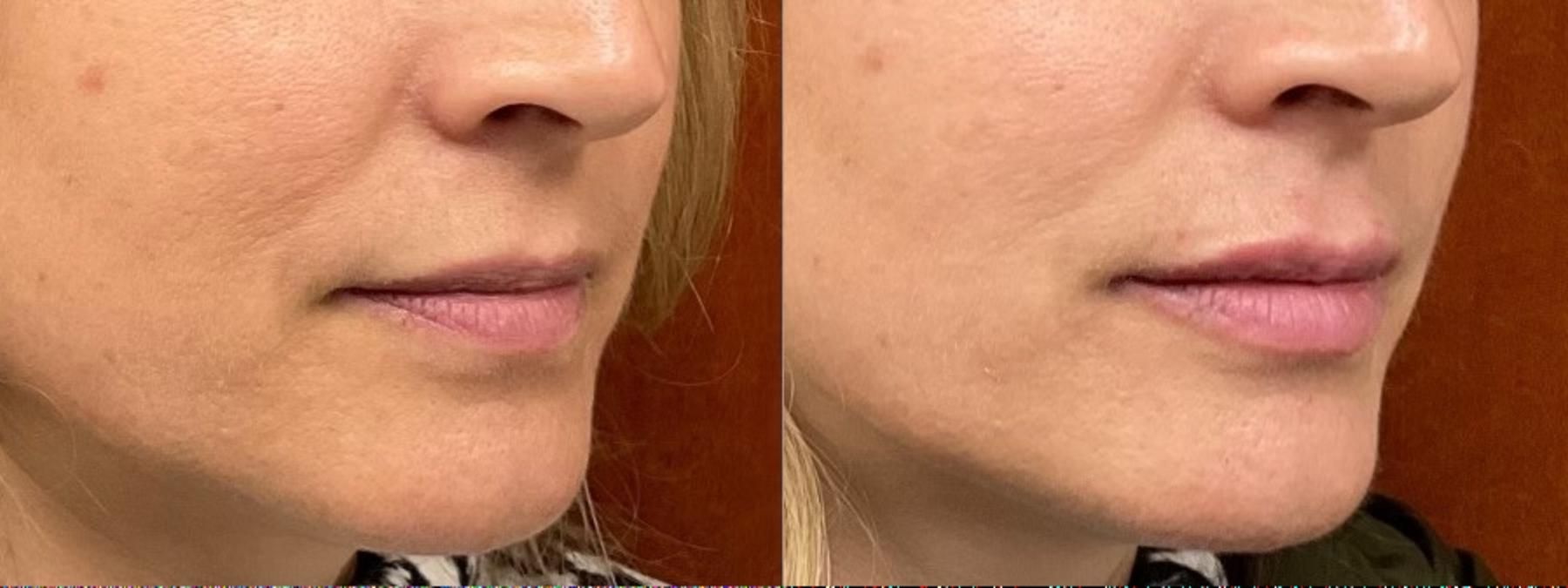 Before & After Lip Filler Case 4 Right Oblique View in Eugene, Oregon