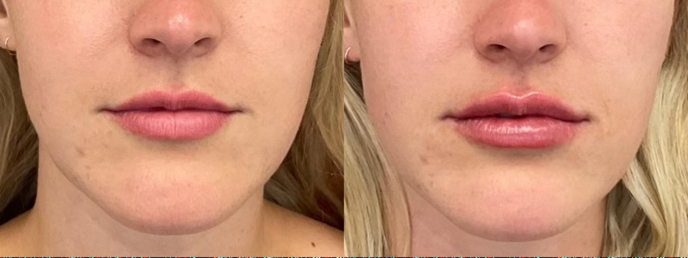 Before & After Lip Filler Case 5 Front View in Eugene, Oregon