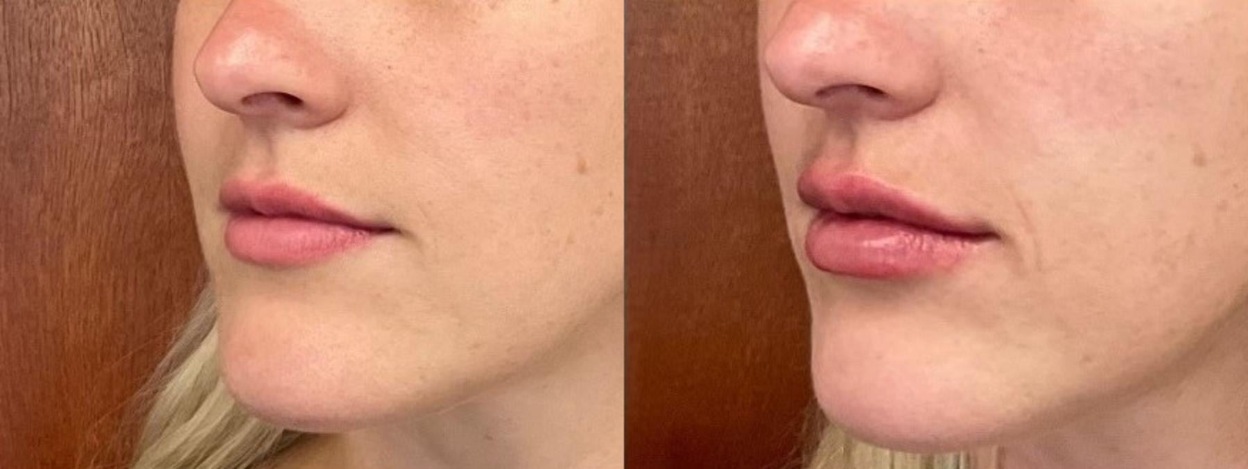 Before & After Lip Filler Case 5 Left Oblique View in Eugene, Oregon
