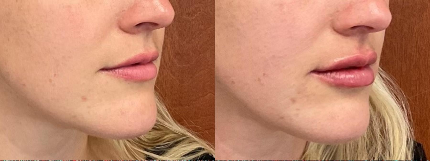 Before & After Lip Filler Case 5 Right Oblique View in Eugene, Oregon