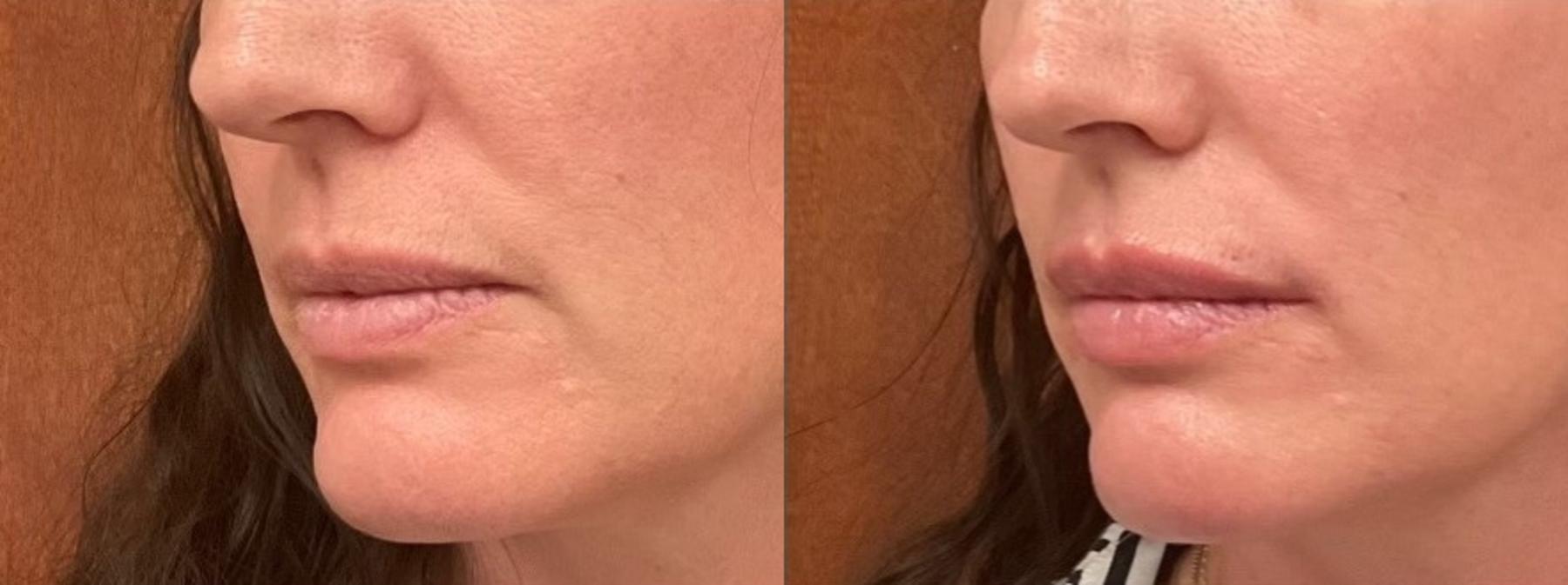 Before & After Lip Filler Case 6 Left Oblique View in Eugene, Oregon