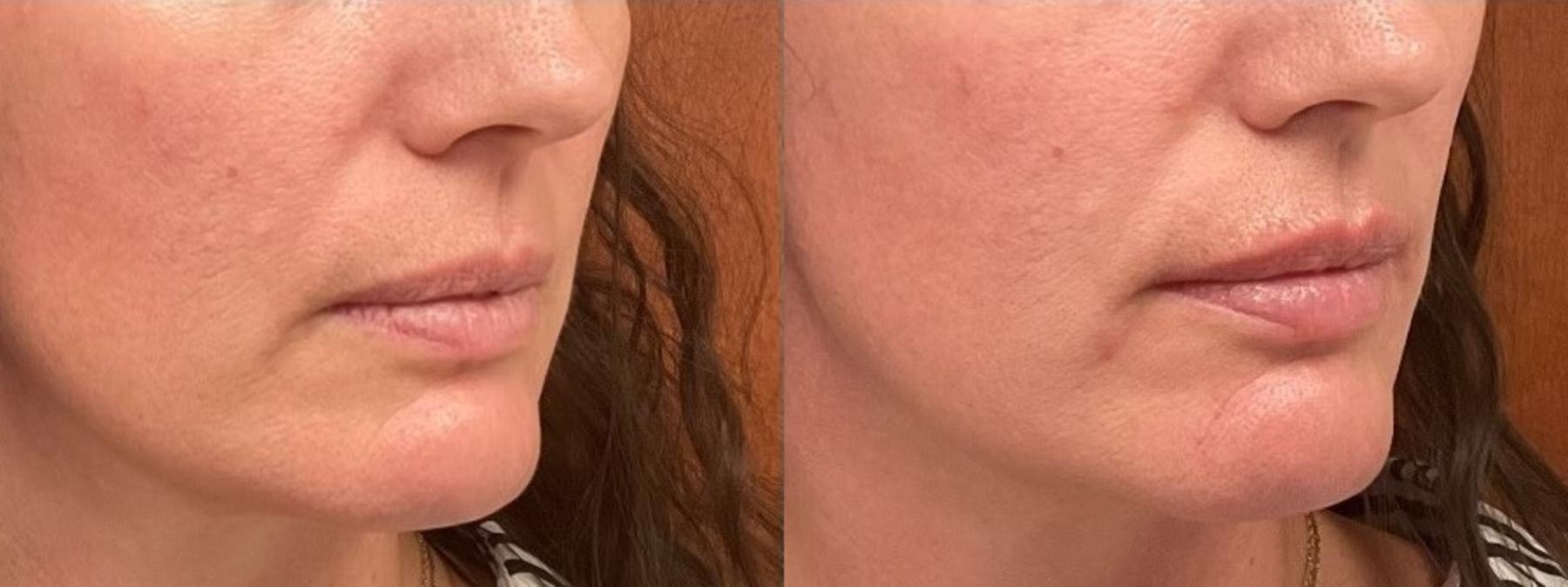 Before & After Lip Filler Case 6 Right Oblique View in Eugene, Oregon